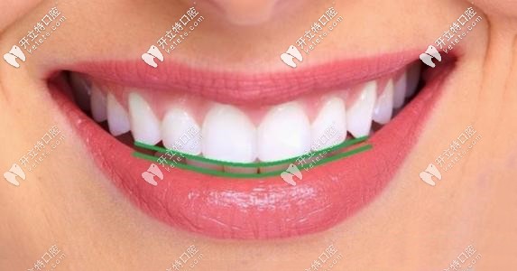 DSD美學(xué)微笑曲線設(shè)計