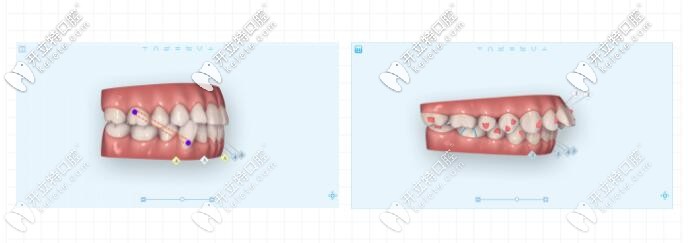 牙齒錯頜畸形矯正