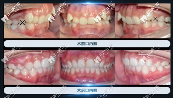 熊安鳳醫(yī)生牙齒矯正案例