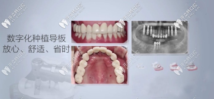 數(shù)字化導板種植