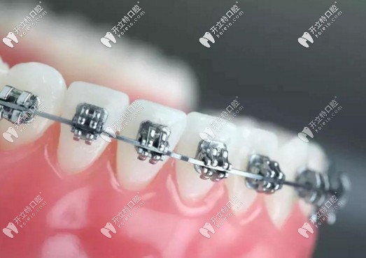 金屬自鎖牙套照片