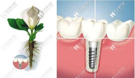 種植牙的重要性