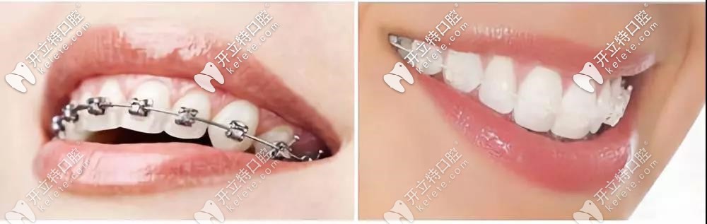 傳統(tǒng)金屬牙套托槽