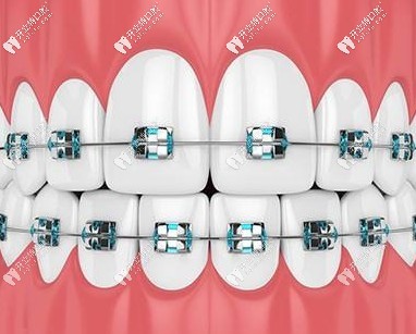 重慶惠城區(qū)的齊美口腔醫(yī)院做3m自鎖托槽矯正好不好？價格呢