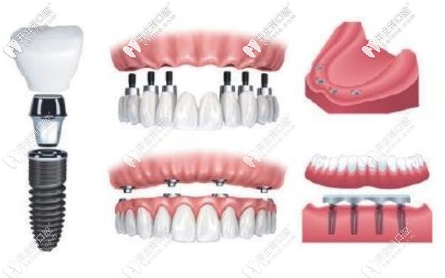 溫州市做全口種植牙價格是多少錢!上萬的種植牙值得做嗎?