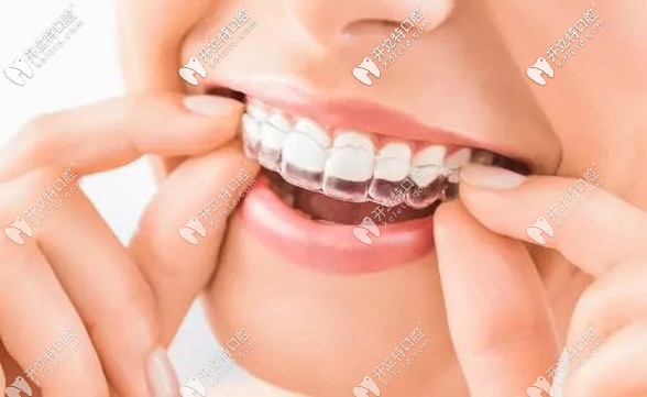 聽說國外建議戴著隱形牙套吃東西,那不會磨損矯正器嗎？