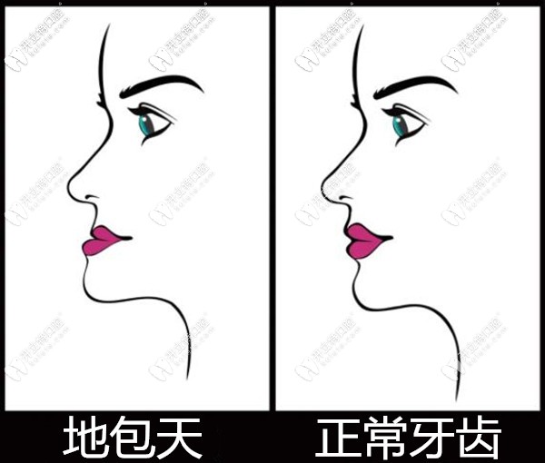 兒童地包天牙齒矯正幾歲效果更好