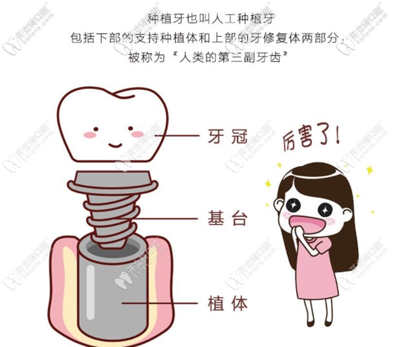 種植牙原理介紹