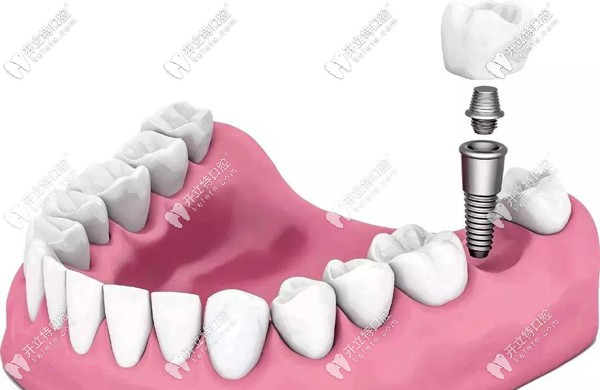 全新的廣州廣大口腔種植牙價格表已整理好,含7國植體品牌哦