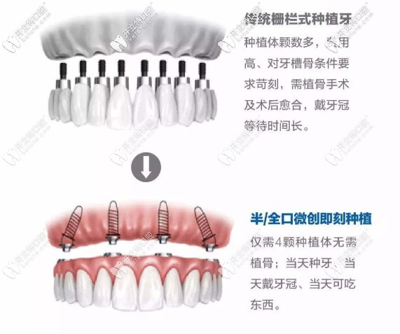 即刻負重種植牙