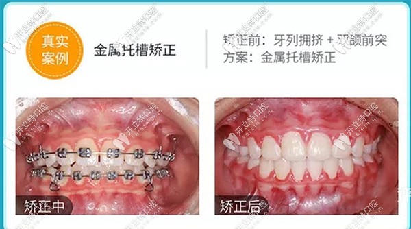 金屬托槽矯正真實案例