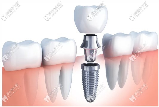 韓國奧齒泰種植牙
