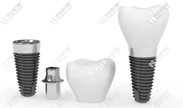 忻州種植牙參考價格