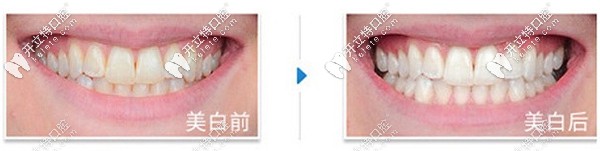 皓齒美白真實案例