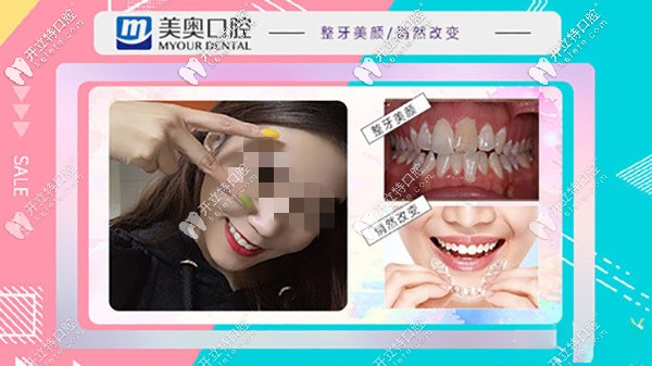 昆明美奧做矯正牙齒怎么樣?時(shí)代天使全隱形牙套收費(fèi)太劃算