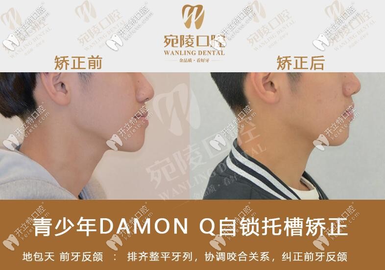 地包天矯正前后臉型對(duì)比照片