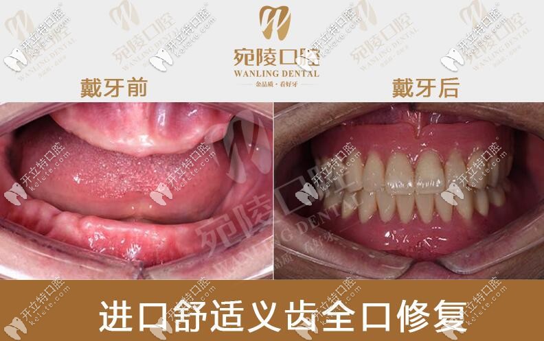 宛陵口腔全口吸附義齒對(duì)比圖