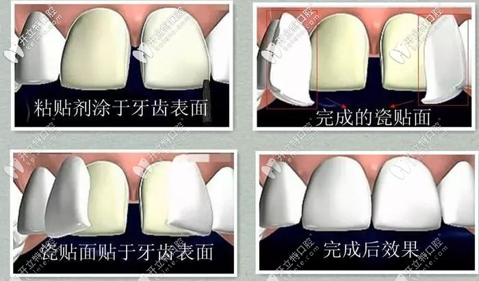 牙齒貼片修復牙縫