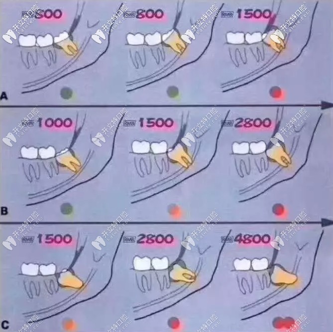 下頜近中傾斜阻生智齒價(jià)格表