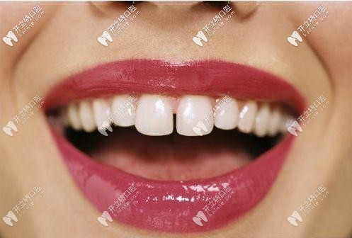 成年人門(mén)牙牙縫大怎么修復(fù)好？去做矯正還是貼面