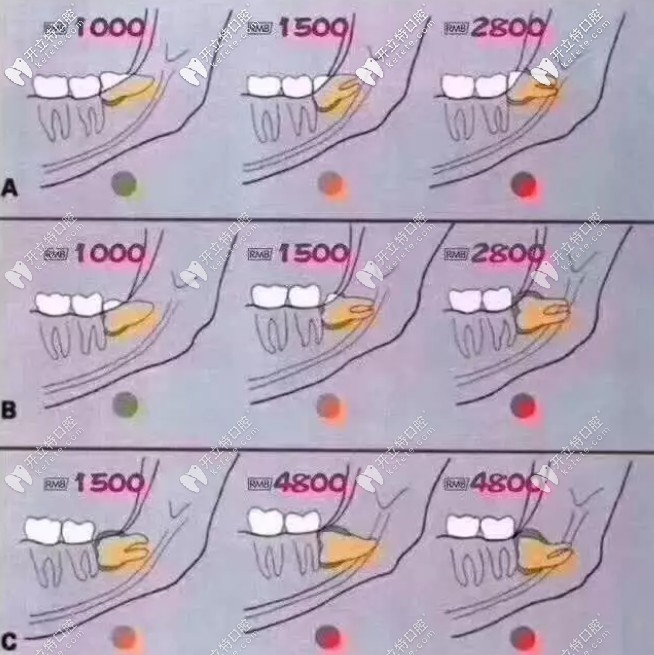 下頜水平阻生智齒價(jià)格表