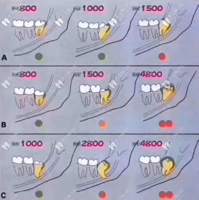下頜遠(yuǎn)中傾斜智齒價(jià)格表