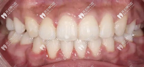 虎牙隱形矯正史-歷時(shí)1年8個(gè)月戴了60副隱適美牙套...