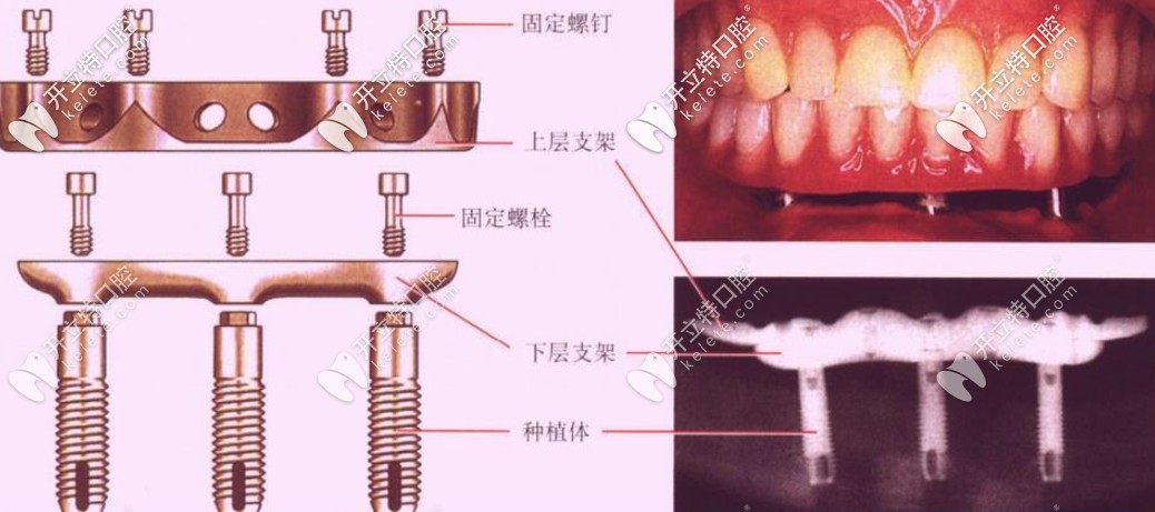 即刻負(fù)重種植牙靠譜嗎？和常規(guī)種植牙相比哪個(gè)好？