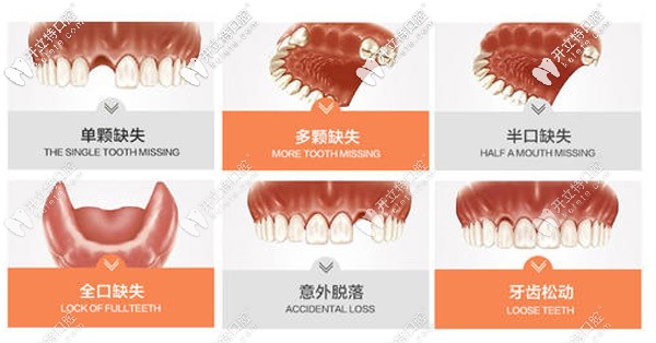 哪些情況需要做種植牙