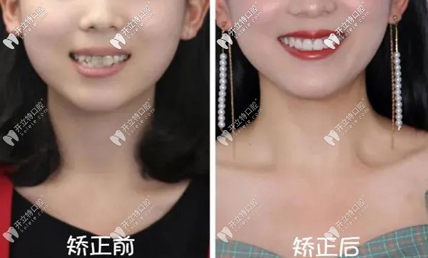 哇~22歲重度齙牙的我做了正雅日夜版隱形矯正竟然逆襲！
