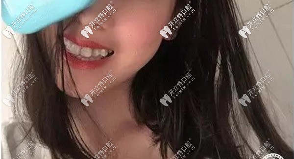 齙牙正畸 齙牙正畸