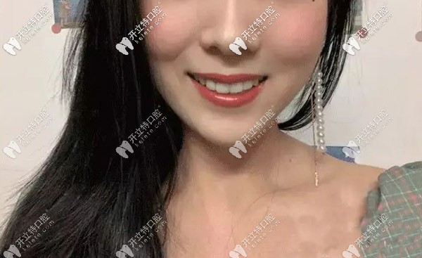 齙牙隱形矯正效果 齙牙隱形矯正效果