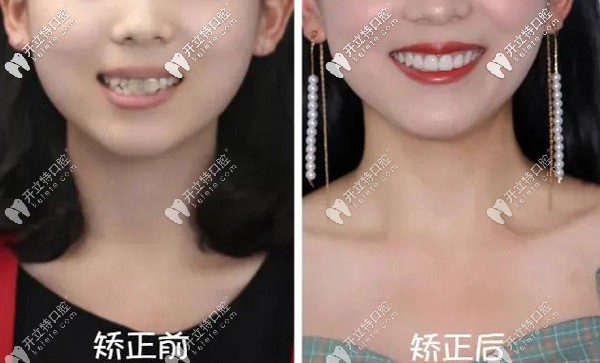 齙牙矯正 齙牙矯正