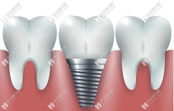 陽泉康貝齒科種植牙價(jià)格