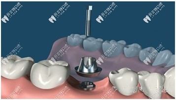 種植牙構(gòu)造