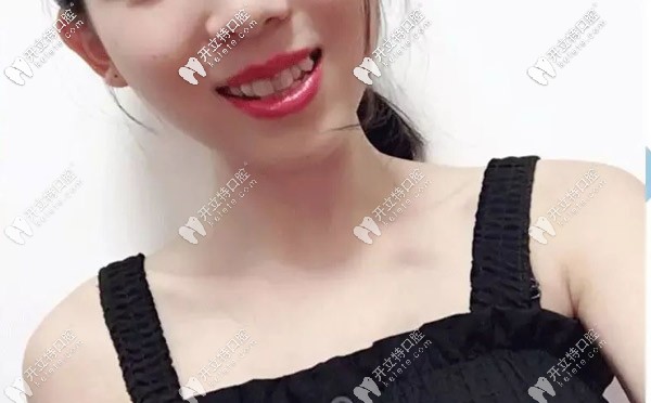 正雅日夜版隱形矯正 正雅日夜版隱形矯正