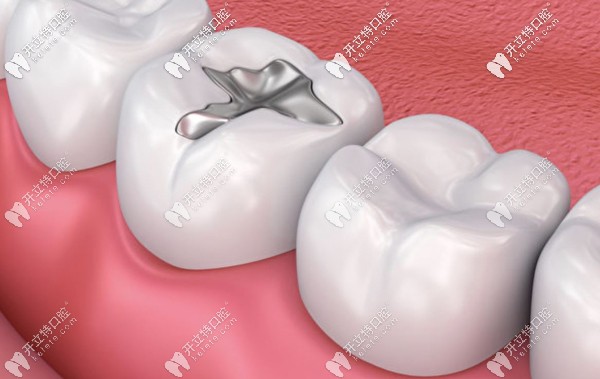 陽泉市的補(bǔ)牙參考價格