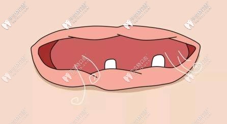 牙齒慢慢就脫落完了