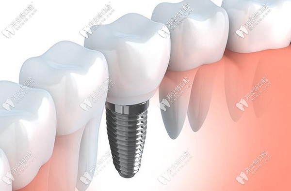 陽泉市種植牙參考價格