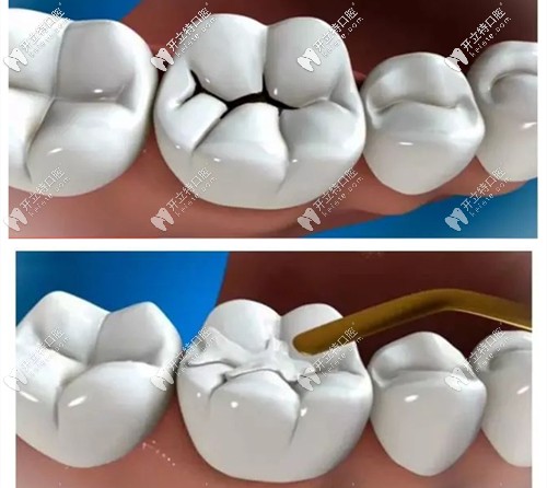 補(bǔ)牙材料不同收費(fèi)也不同