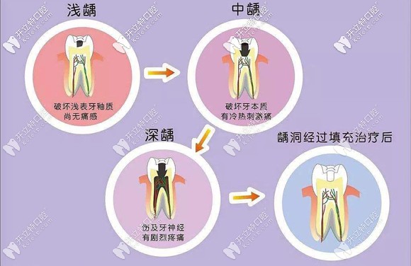 不同補(bǔ)牙技術(shù)也決定了補(bǔ)牙的收費(fèi)