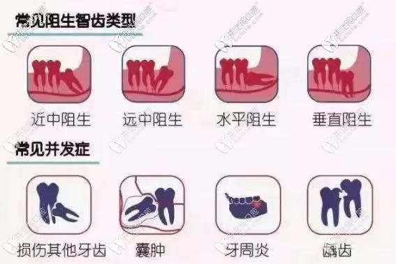 常見阻生智齒的類型以及并發(fā)癥