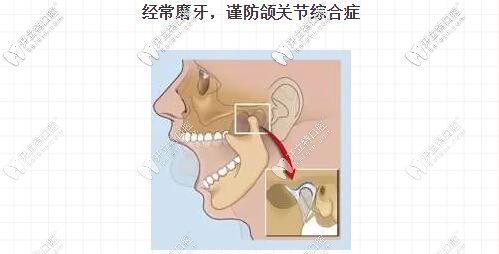 磨牙可能導(dǎo)致的疾病