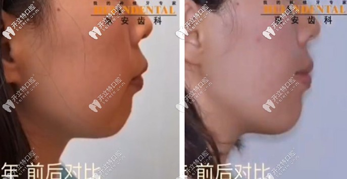 看呆！凸嘴少女在惠安齒科戴自鎖托槽矯正半年后…