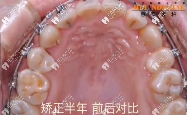 上牙變得很整齊