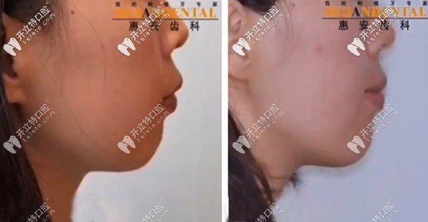 通過矯正可能獲得一個下巴哦