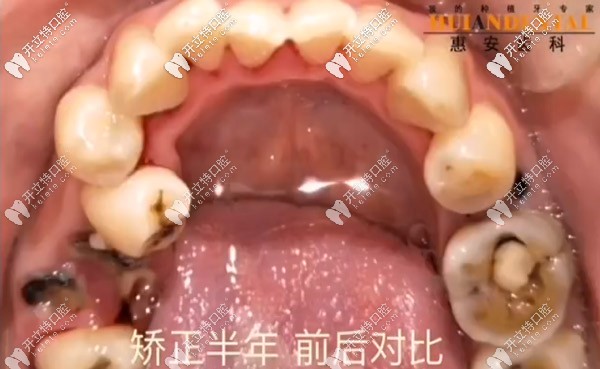 由于牙齒擁擠導(dǎo)致蛀牙較多