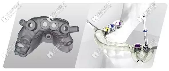 南寧悅美口腔數(shù)字化導(dǎo)航種植牙