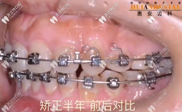 矯正半年后側(cè)面也好看了