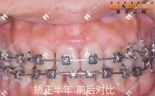 矯正半年后牙齒變整齊了